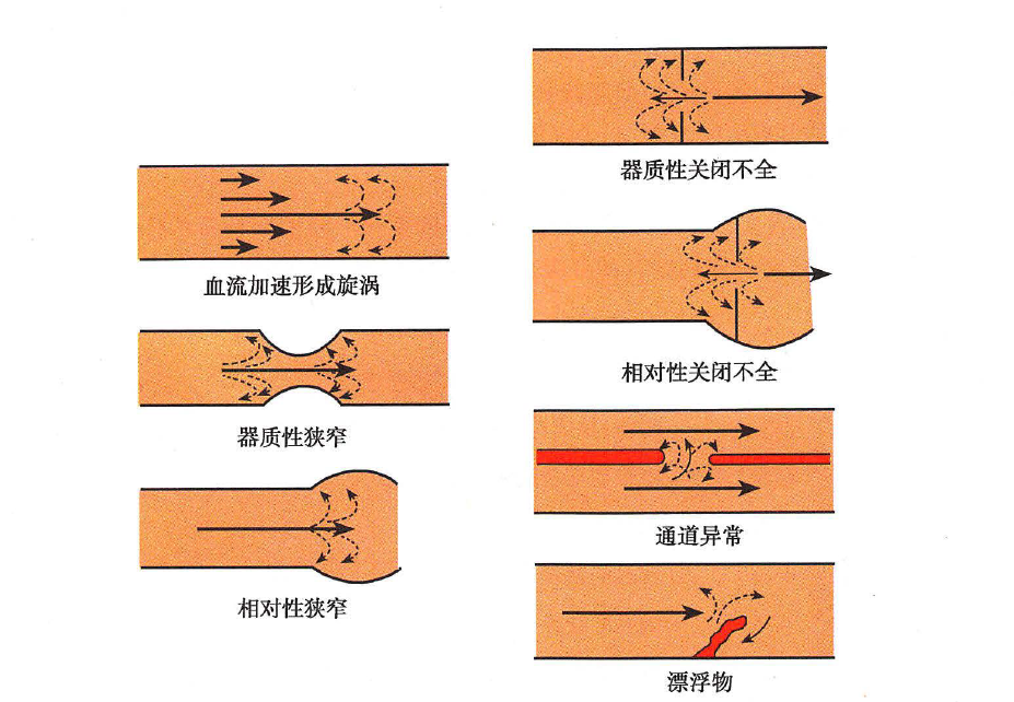 杂音机制